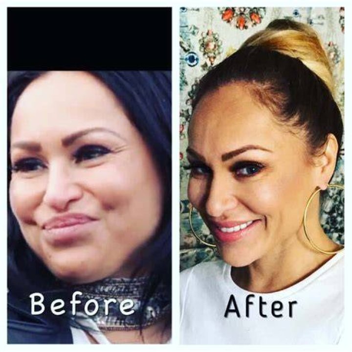 Darcey Silva before and after plastic surgery.