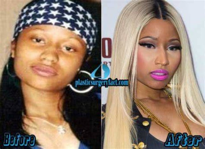 Nicki Minaj - before surgery and after plastic surgery