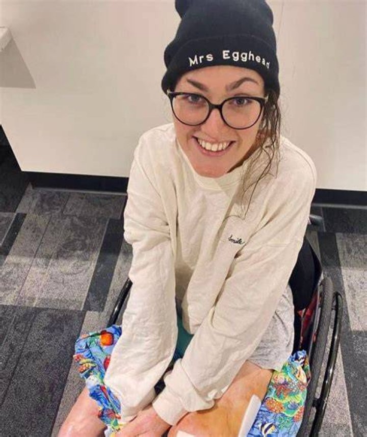 Sophie Delezio Accident Update: Burn Survivior Surgery And Health 2023 Sophie Delezio Surgery