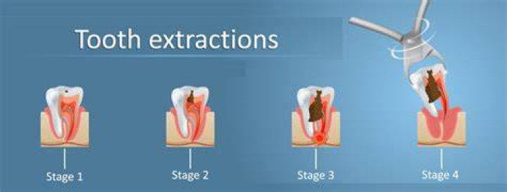 tooth extraction procedure tooth extraction procedure