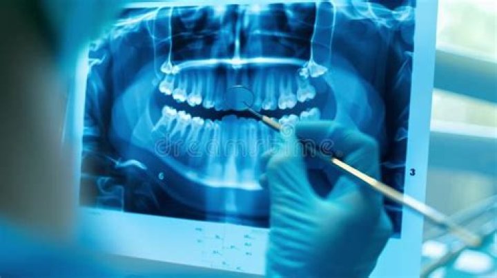 X-rays for extraction X-rays for extraction